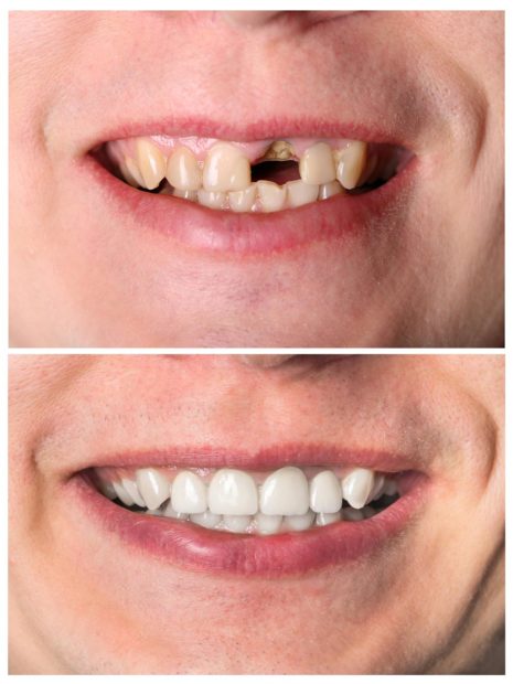 Tooth Implant before and after in Shoreline, Washington