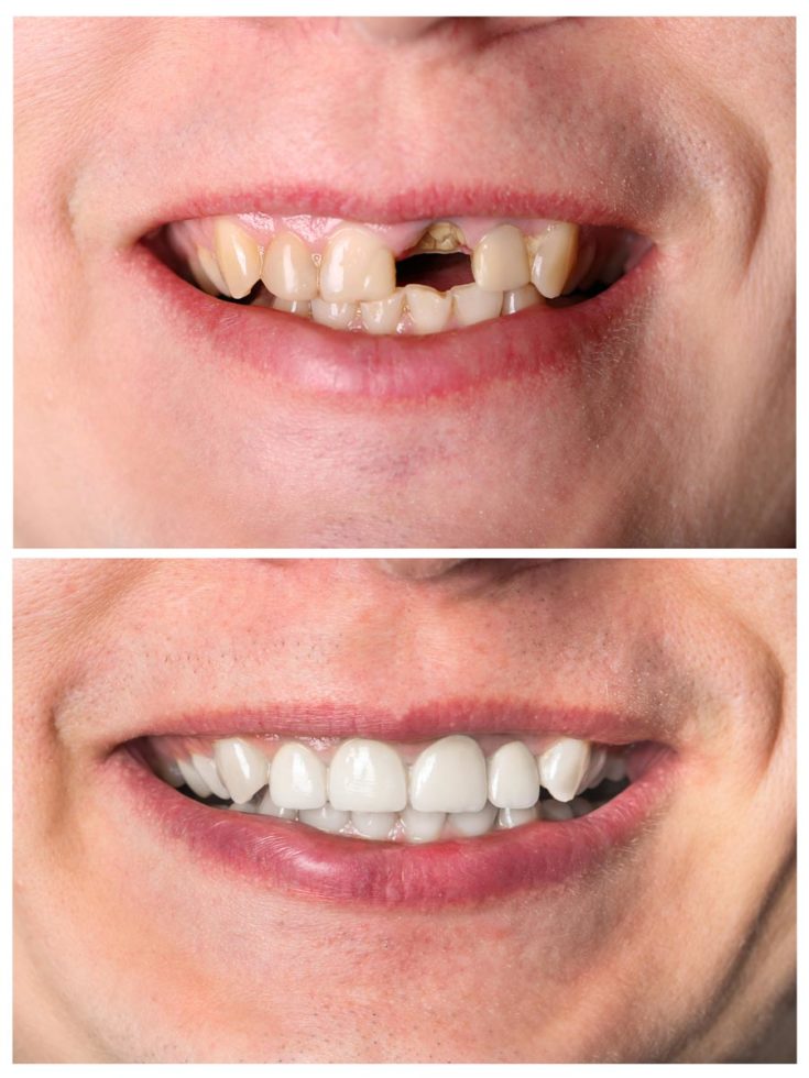 Dental Implants in Ballard WA, Shoreline, Seattle