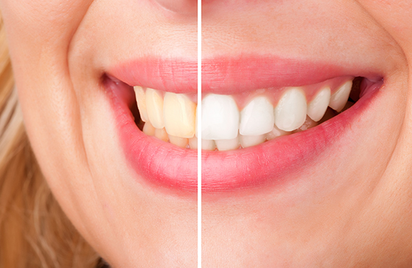 Teeth Whitening in Seattle, Shoreline, Ballard WA, Fremont WA, Greenwood WA