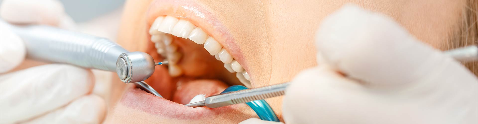 Teeth Cleaning in Shoreline, Seattle, Ballard, WA, Greenwood, WA