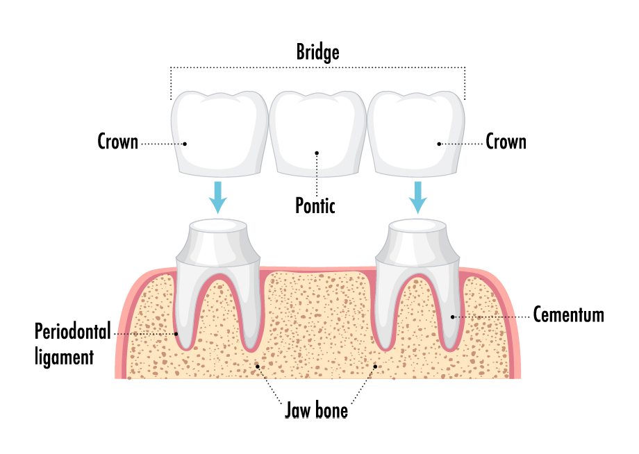 Dental implant bridge example