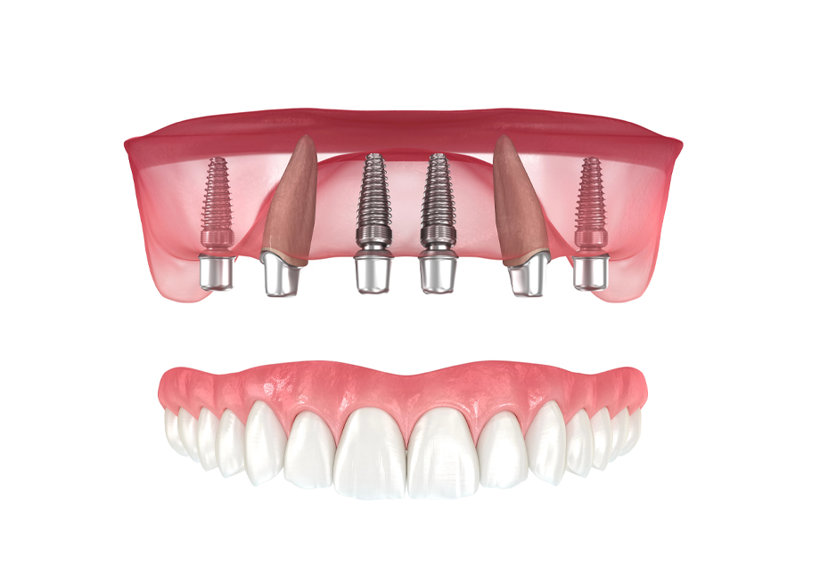 Implant supported denture example