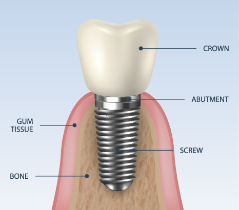 Dental Implant Diagram