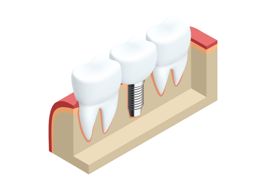 Dental implant example patient 1